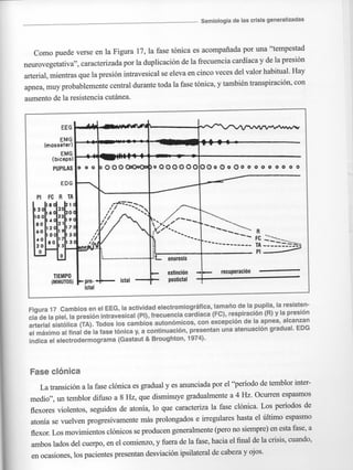 Marzia elsa   crisis-epilepticas