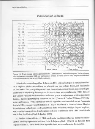 Marzia elsa   crisis-epilepticas