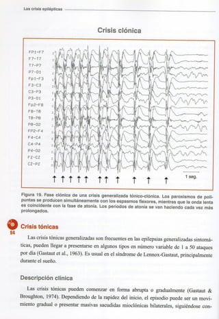 Marzia elsa   crisis-epilepticas