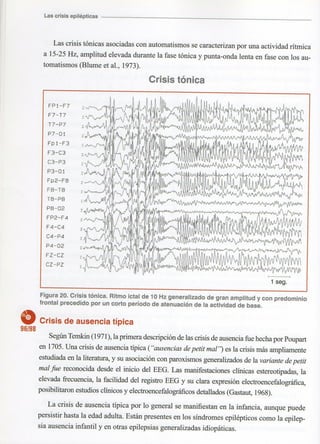 Marzia elsa   crisis-epilepticas