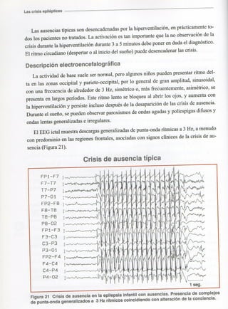 Marzia elsa   crisis-epilepticas