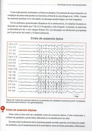 Marzia elsa   crisis-epilepticas