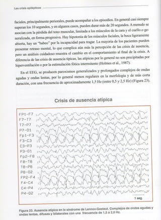 Marzia elsa   crisis-epilepticas