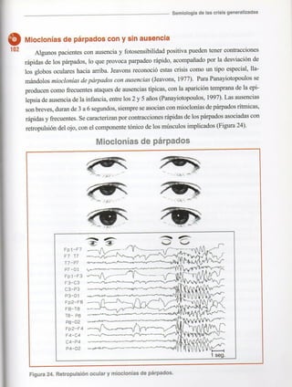 Marzia elsa   crisis-epilepticas