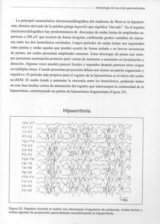 Marzia elsa   crisis-epilepticas