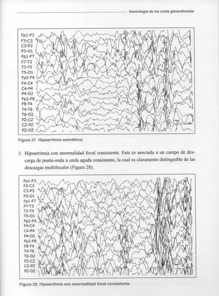 Marzia elsa   crisis-epilepticas