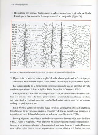 Marzia elsa   crisis-epilepticas