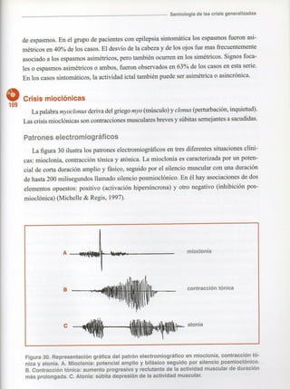 Marzia elsa   crisis-epilepticas