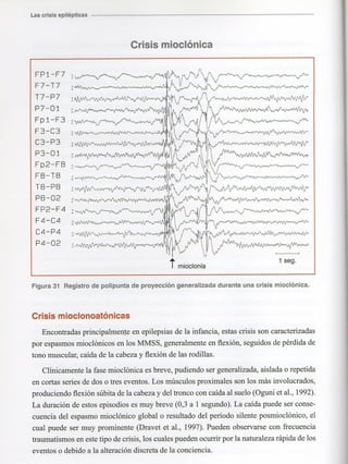 Marzia elsa   crisis-epilepticas