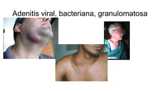 Adenitis viral, bacteriana, granulomatosa
 