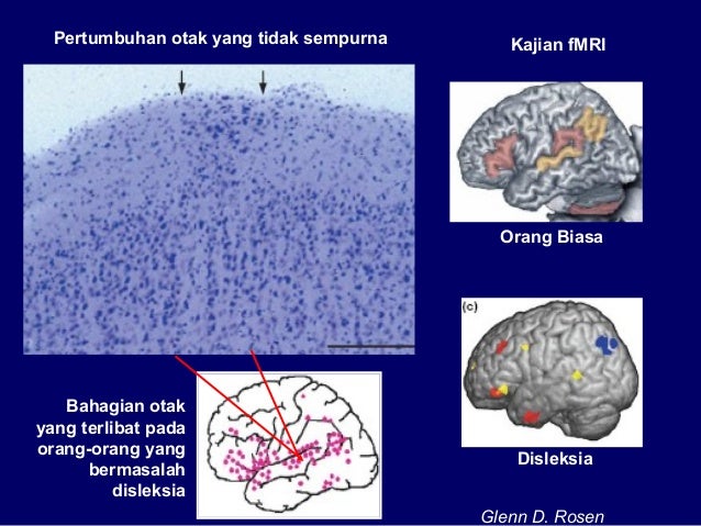 Masalah pembelajaran spesifik disleksia dari sudut perubatan