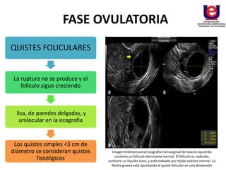 FASE OVULATORIA
QUISTES FOLICULARES
La ruptura no se produce y el
folículo sigue creciendo
lisa, de paredes delgadas, y
unilocular en la ecografía
Los quistes simples <3 cm de
diámetro se consideran quistes
fisiológicos
Imagen tridimensional ecografía transvaginal del ovario izquierdo
contiene un folículo dominante normal. El folículo es redonda,
contiene un líquido claro, y está rodeado por tejido ovárico normal. La
flecha gruesa está apuntando al quiste folicular en una dimensión
 