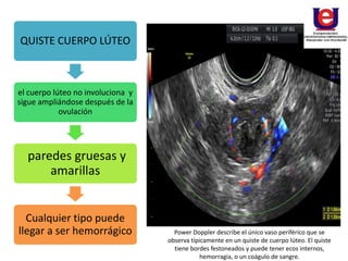 QUISTE CUERPO LÚTEO
el cuerpo lúteo no involuciona y
sigue ampliándose después de la
ovulación
paredes gruesas y
amarillas
Cualquier tipo puede
llegar a ser hemorrágico Power Doppler describe el único vaso periférico que se
observa típicamente en un quiste de cuerpo lúteo. El quiste
tiene bordes festoneados y puede tener ecos internos,
hemorragia, o un coágulo de sangre.
 