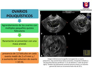 OVARIOS
POLIQUÍSTICOS
Agrandamiento de los ovarios con
múltiples pequeños quistes
foliculares
Raramente se presentan con una
masa anexial.
presencia de 12 folículos en cada
ovario medir de 2 a 9 mm y /
o aumento del volumen de ovario
> 10 ml,
Imagen tridimensional ecografía transvaginal de un ovario
poliquístico. Hay características típicas presentes, incluyendo múltiples (>
10) pequeños folículos periféricos <1 cm de diámetro ( "collar de perlas"
signo). También hay típicamente aumentó estroma central, y el volumen
general del ovario se incrementa hasta más de 10 cc
 