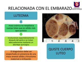 RELACIONADA CON EL EMBARAZO
LUTEOMA
masa ovárica no neoplásica
cuerpo lúteo que es sólido más
que quístico
involucionan espontáneamente
después del parto o se tratan
adecuadamente mediante un
abordaje quirúrgico
El diagnóstico debe ser
sospechado en presencia de una
masa anexial sólida y hirsutismo
maternal o virilización
QUISTE CUERPO
LUTEO
 