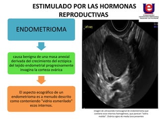 ENDOMETRIOMA
causa benigna de una masa anexial
derivada del crecimiento del ectópica
del tejido endometrial progresivamente
invagina la corteza ovárica
El aspecto ecográfico de un
endometrioma es a menudo descrito
como conteniendo "vidrio esmerilado"
ecos internos.
ESTIMULADO POR LAS HORMONAS
REPRODUCTIVAS
imagen de ultrasonido transvaginal de endometrioma que
contiene ecos internos homogéneos, que parecen "vidrio
molido". Ovárica signo de media luna presentes
 
