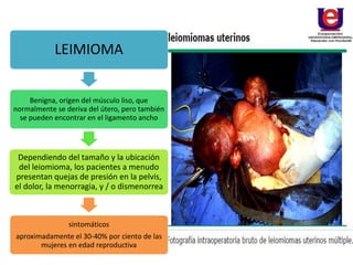 LEIMIOMA
Benigna, origen del músculo liso, que
normalmente se deriva del útero, pero también
se pueden encontrar en el ligamento ancho
Dependiendo del tamaño y la ubicación
del leiomioma, los pacientes a menudo
presentan quejas de presión en la pelvis,
el dolor, la menorragia, y / o dismenorrea
sintomáticos
aproximadamente el 30-40% por ciento de las
mujeres en edad reproductiva
 