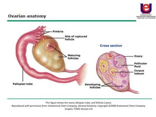 This figure shows the ovary, fallopian tube, and follicles (cysts).
Reproduced with permission from: Anatomical Chart Company, General Anatomy. Copyright ©2008 Anatomical Chart Company.
Graphic 77045 Version 4.0
 