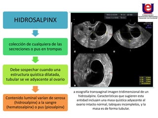 HIDROSALPINX
colección de cualquiera de las
secreciones o pus en trompas
Debe sospechar cuando una
estructura quística dilatada,
tubular se ve adyacente al ovario
Contenido luminal varían de serosa
(hidrosalpinx) a la sangre
(hematosalpinx) o pus (piosalpinx)
a ecografía transvaginal imagen tridimensional de un
hidrosalpinx. Características que sugieren esta
entidad incluyen una masa quística adyacente al
ovario intacto normal, tabiques incompletos, y la
masa es de forma tubular.
 