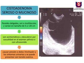 CISTOADENOMA
SEROSO O MUCINOSO
Paredes delgadas, uni o multilocular,
y varían en tamaño de 5 a <20 cm
son asintomáticos y descubren por
casualidad en el examen pélvico o
con ultrasonido
causar presión o dolor, hinchazón y
los síntomas urinarios y se puede
presentar con torsión ovárica.
 