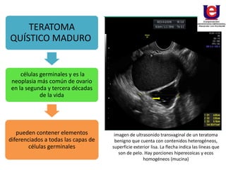 TERATOMA
QUÍSTICO MADURO
células germinales y es la
neoplasia más común de ovario
en la segunda y tercera décadas
de la vida
pueden contener elementos
diferenciados a todas las capas de
células germinales
imagen de ultrasonido transvaginal de un teratoma
benigno que cuenta con contenidos heterogéneos,
superficie exterior lisa. La flecha indica las líneas que
son de pelo. Hay porciones hiperecoicas y ecos
homogéneos (mucina)
 