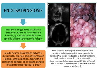 ENDOSALPINGIOSIS
presencia de glándulas quísticas
ectópicas, fuera de la trompa de
Falopio, que están revestidas con
epitelio ciliado tipo tubo de Falopio
puede ocurrir en órganos pélvicos,
incluyendo ovarios, serosa trompa de
Falopio, serosa uterina, miometrio o
peritoneo pélvico. en la vejiga ,ganglio
linfático retroperitoneal o axilar
El ultrasonido transvaginal mostró formaciones
quísticas en las áreas de la trompa derecha de
Falopio (A) y úteros fundus (B). El diámetro máximo
de los quistes era de 7,5 cm. presentación
laparoscópica de la masa quística (C); útero (frontal)
con el tubo de la derecha y de la pared abdominal
derecha (de fondo).
 