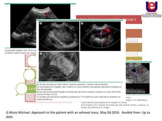 El dolor pélvico
crescendo subito (90%)
Masa anexial
Náuseas y vómitos (47-
70 %)
Fiebre (2 a 20%)
Sangrado de tracto
genital (4%)
CH: anemia y
leucocitosis
Ecografía
RMN
TC
ovario que es redondeada y ampliada (edema y congestión vascular )
Masa ovárica
Apariencia heterogénea del estroma ovárico
Pequeños folículos periféricos múltiples ( "collar de perlas")
Ubicación anormal de los ovarios
La disminución o ausencia de flujo Doppler en el ovario
G.Muto Michael. Approach to the patient with an adnexal mass. May 04.2016. Avaible from: Up to
date.
 
