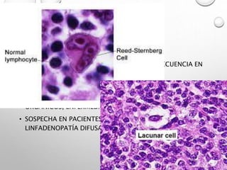 LINFOMA
• DESORDEN LINFOPROLIFERATIVO. MAYOR FRECUENCIA EN
NIÑOS Y ADULTOS JÓVENES
• NIÑOS CON LH: 80% PRESENTAN MASAS DE CUELLO
• FACTORES DE RIESGO: EPSTEIN BARR, VIH, TÓXICOS
ORGÁNICOS, ENFERMEDADES INMUNOLÓGICAS
• SOSPECHA EN PACIENTES CON FIEBRE, ESCALOFRÍOS,
LINFADENOPATÍA DIFUSA
 