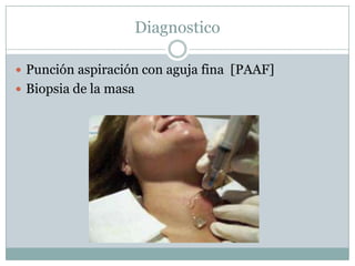 Diagnostico

 Punción aspiración con aguja fina [PAAF]
 Biopsia de la masa
 
