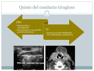 Quiste del conducto tirogloso


USO
• lesiones hipo o
  anecogénicas.
• finos tabiques y sus paredes   TC
  pueden ser gruesas             • lesiones con densidadlíquida,
                                   bien delimitadas, uniloculares
 