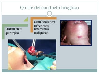 Quiste del conducto tirogloso

                Complicaciones:
                Infecciones
Tratamiento:    recurrentes
quirurgico      malignidad
 