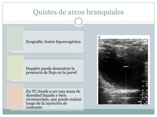 Quistes de arcos branquiales


Ecografía: lesión hipoecogénica




Doppler puede demostrar la
presencia de flujo en la pared



En TC tiende a ser una masa de
densidad líquida y bien
circunscripta, que puede realzar
luego de la inyección de
contraste
 