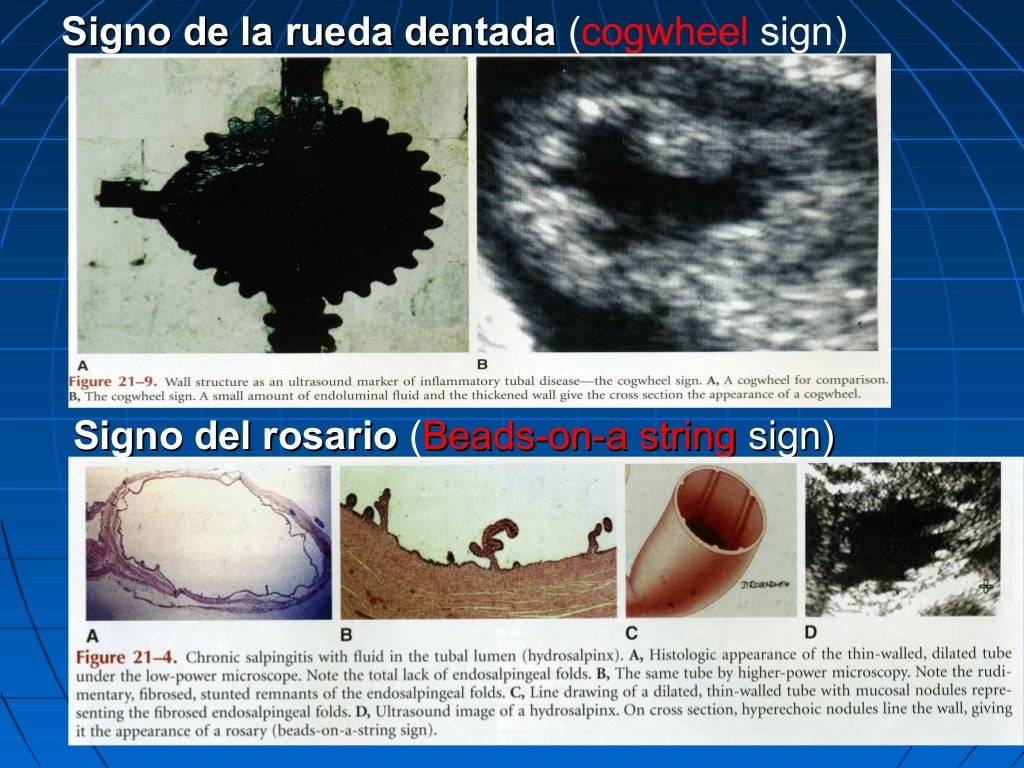 Masas ováricas2