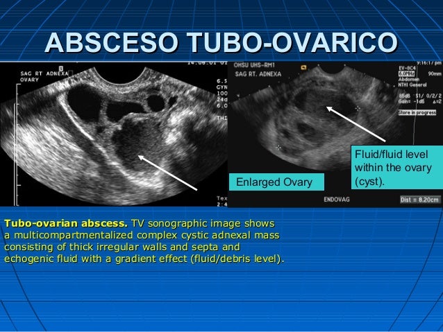 Masas ováricas2