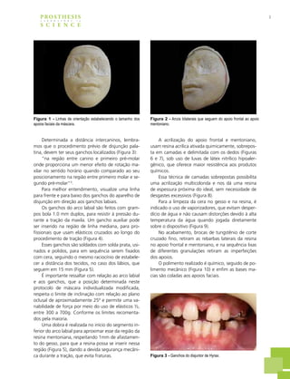 3PROSTHESIS
S C I E N C E
L A B O R A T O R Y i n
Determinada a distância intercaninos, lembra-
mos que o procedimento prévio de disjunção pala-
tina, devem ter seus ganchos localizados (Figura 3):
“na região entre canino e primeiro pré-molar
onde proporciona um menor efeito de rotação ma-
xilar no sentido horário quando comparado ao seu
posicionamento na região entre primeiro molar e se-
gundo pré-molar”3
.
Para melhor entendimento, visualize uma linha
para frente e para baixo dos ganchos do aparelho de
disjunção em direção aos ganchos labiais.
Os ganchos do arco labial são feitos com gram-
pos bola 1.0 mm duplos, para resistir à pressão du-
rante a tração da maxila. Um gancho auxiliar pode
ser inserido na região de linha mediana, para pro-
fissionais que usam elásticos cruzados ao longo do
procedimento de tração (Figura 4).
Esses ganchos são soldados com solda prata, usi-
nados e polidos, para em sequência serem fixados
com cera, seguindo o mesmo raciocínio de estabele-
cer a distância dos tecidos, no caso dos lábios, que
seguem em 15 mm (Figura 5).
É importante ressaltar com relação ao arco labial
e aos ganchos, que a posição determinada neste
protocolo de máscara individualizada modificada,
respeita o limite de inclinação com relação ao plano
oclusal de aproximadamente 25º e permite uma va-
riabilidade de força por meio do uso de elásticos ½,
entre 300 a 700g. Conforme os limites recomenta-
dos pela maioria.
Uma dobra é realizada no início do segmento in-
ferior do arco labial para aproximar esse da região da
resina mentoniana, respeitando 1mm de afastamen-
to do gesso, para que a resina possa se inserir nessa
região (Figura 5), dando a devida segurança mecâni-
ca durante a tração, que evita fraturas.
A acrilização do apoio frontal e mentoniano,
usam resina acrílica ativada quimicamente, sobrepos-
ta em camadas e delimitada com os dedos (Figuras
6 e 7), sob uso de luvas de látex nitrílico hipoaler-
gênico, que oferece maior resistência aos produtos
químicos.
Essa técnica de camadas sobrepostas possibilita
uma acrilização multicolorida e nos dá uma resina
de espessura próxima do ideal, sem necessidade de
desgastes excessivos (Figura 8).
Para a limpeza da cera no gesso e na resina, é
indicado o uso de vaporizadores, que evitam desper-
dício de água e não causam distorções devido à alta
temperatura da água quando jogada diretamente
sobre o dispositivo (Figura 9).
No acabamento, brocas de tungstênio de corte
cruzado fino, retiram as rebarbas laterais da resina
no apoio frontal e mentoniano, e na sequência lixas
de diferentes granulações retiram as imperfeições
dos apoios.
O polimento realizado é químico, seguido de po-
limento mecânico (Figura 10) e enfim as bases ma-
cias são coladas aos apoios faciais.
Figura 1 - Linhas de orientação estabelecendo o tamanho dos
apoios faciais da máscara.
Figura 2 - Arcos bilaterais que seguem do apoio frontal ao apoio
mentoniano.
Figura 3 - Ganchos do disjuntor de Hyrax.
 