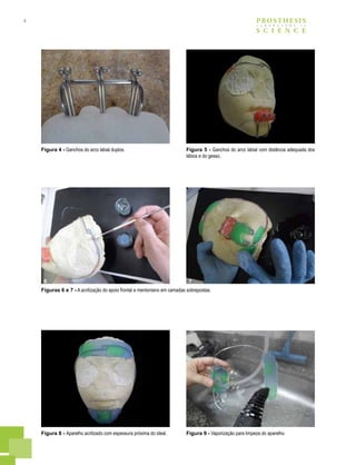 4 PROSTHESIS
S C I E N C E
L A B O R A T O R Y i n
Figura 4 - Ganchos do arco labial duplos. Figura 5 - Ganchos do arco labial com distância adequada dos
lábios e do gesso.
Figuras 6 e 7 - A acrilização do apoio frontal e mentoniano em camadas sobrepostas.
Figura 8 - Aparelho acrilizado com espessura próxima do ideal. Figura 9 - Vaporização para limpeza do aparelho.
6 7
 