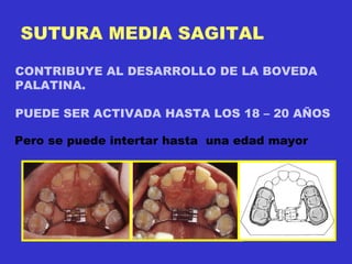 SUTURA MEDIA SAGITAL CONTRIBUYE AL DESARROLLO DE LA BOVEDA PALATINA. PUEDE SER ACTIVADA HASTA LOS 18 – 20 AÑOS Pero se puede intertar hasta  una edad mayor 