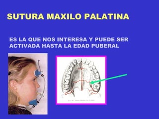 SUTURA MAXILO PALATINA ES LA QUE NOS INTERESA Y PUEDE SER  ACTIVADA HASTA LA EDAD PUBERAL 
