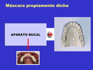 Máscara propiamente dicha APARATO FACIAL APARATO BUCAL 
