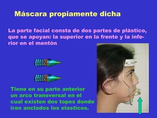 Máscara propiamente dicha La parte facial consta de dos partes de plástico, que se apoyan: la superior en la frente y la infe- rior en el mentón Tiene en su parte anterior un arco transversal en el cual existen dos topes donde iran anclados los elasticos. 