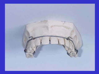 PORCION BUCAL Ambos son de alambre de acero inoxidable Extraduro de 1mm de sección. El arco vestibular contornea las caras vesti- bulares de los dientes y está separado 2mm. El arco palatino contornea las caras palatinas de todas las piezas dentarias. Por distal de los incisivos laterales lleva solda- dos dos ganchos de acero inoxidable de 0.6 mm Este sistema esta constituido por una férula cementada a los primeros molares permanentes o a los segundos molares temporarios. 