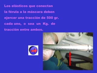 Los elásticos que conectan  la férula a la máscara deben ejercer una tracción de 500 gr. cada uno,  o  sea  un  Kg.  de tracción entre ambos.  
