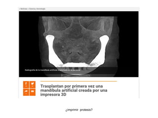 ¿imprimir protesis?
 