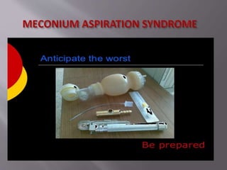 MAS in newborn new.pptx