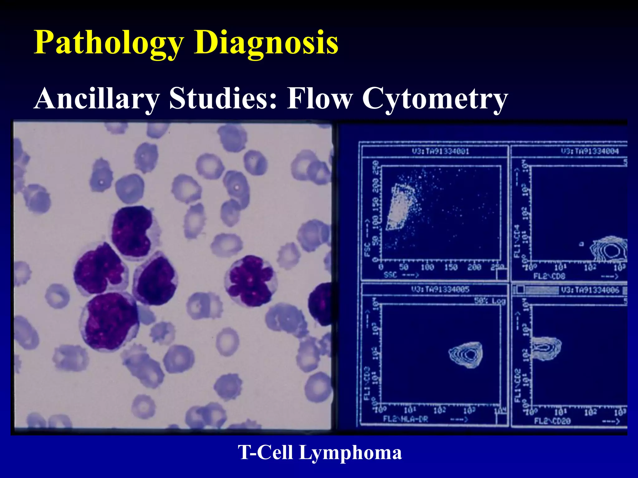 Ancillary Studies: Flow Cytometry
T-Cell Lymphoma
Pathology Diagnosis
 
