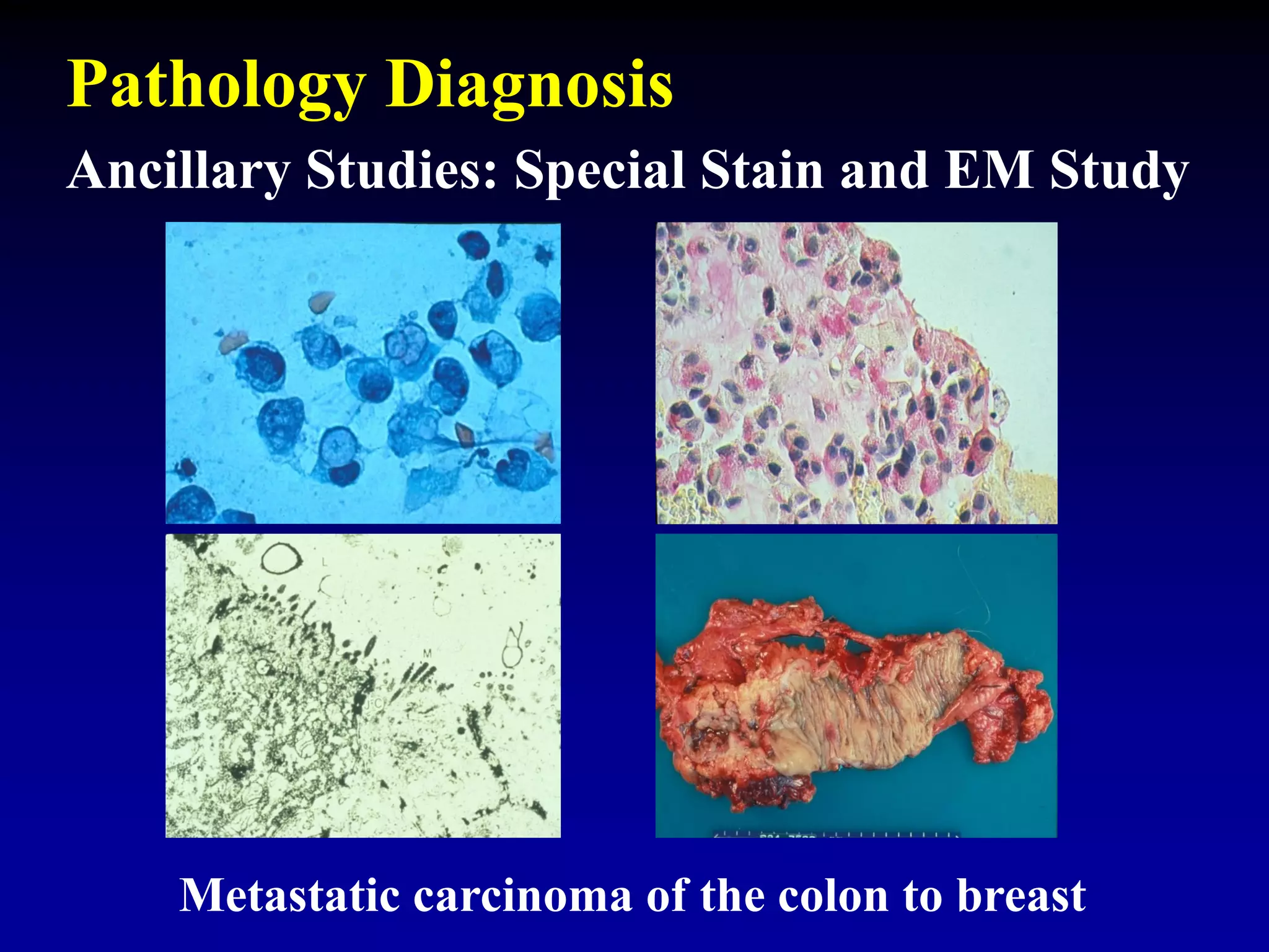 Metastatic carcinoma of the colon to breast
Pathology Diagnosis
Ancillary Studies: Special Stain and EM Study
 