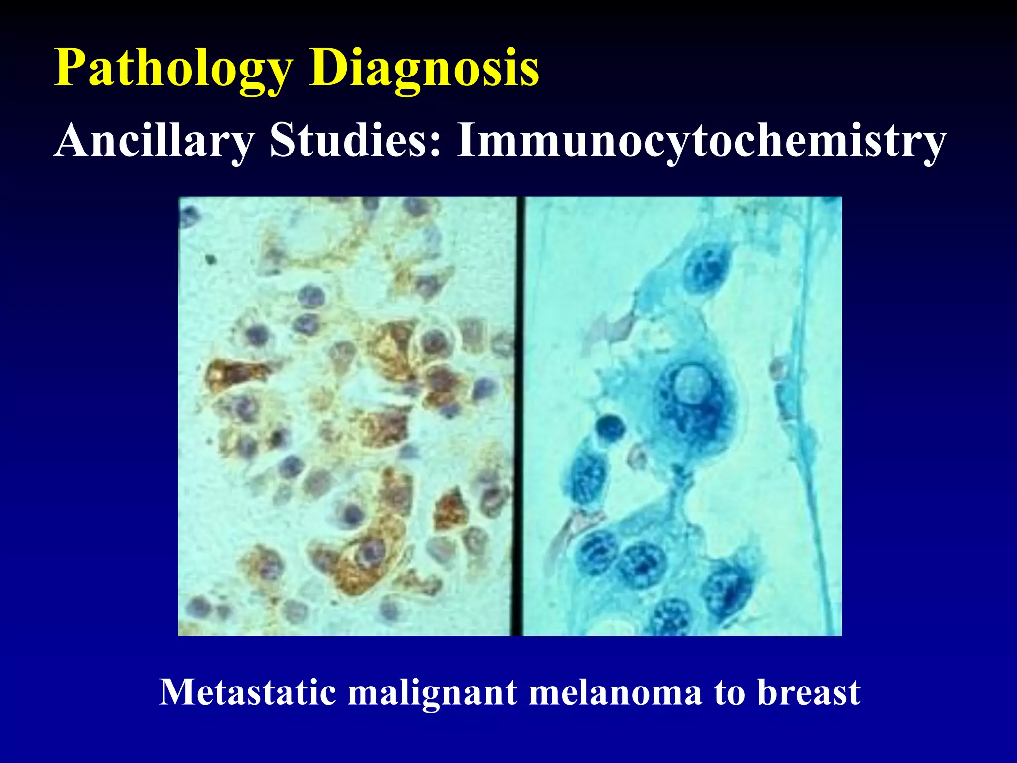 Ancillary Studies: Immunocytochemistry
Metastatic malignant melanoma to breast
Pathology Diagnosis
 