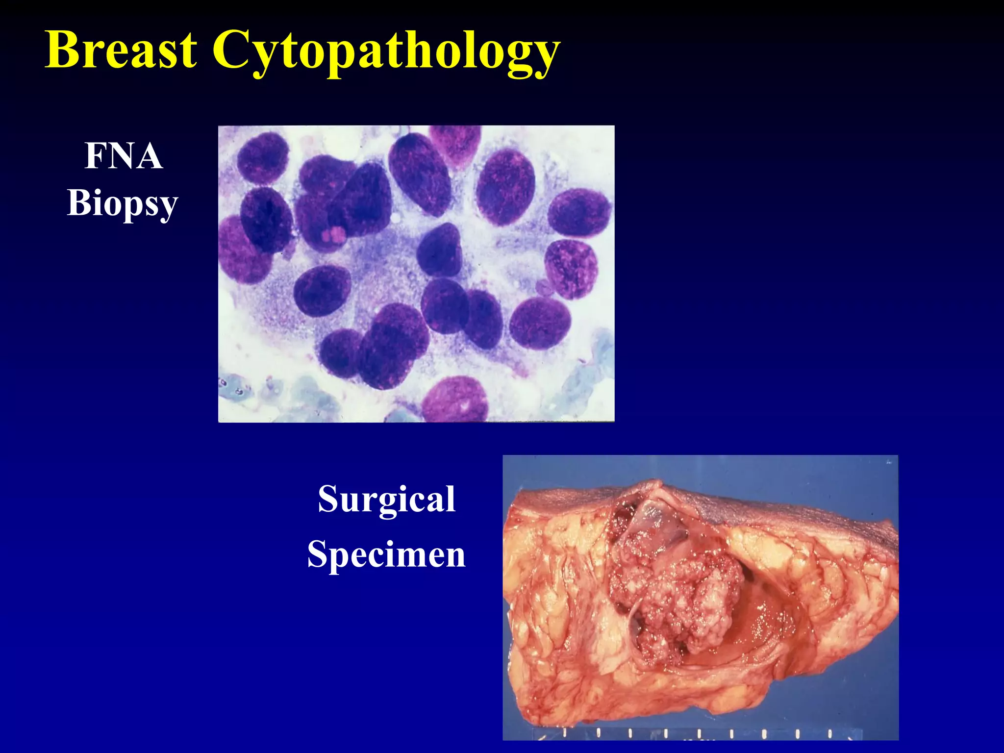 FNA
Biopsy
Surgical
Specimen
Breast Cytopathology
 