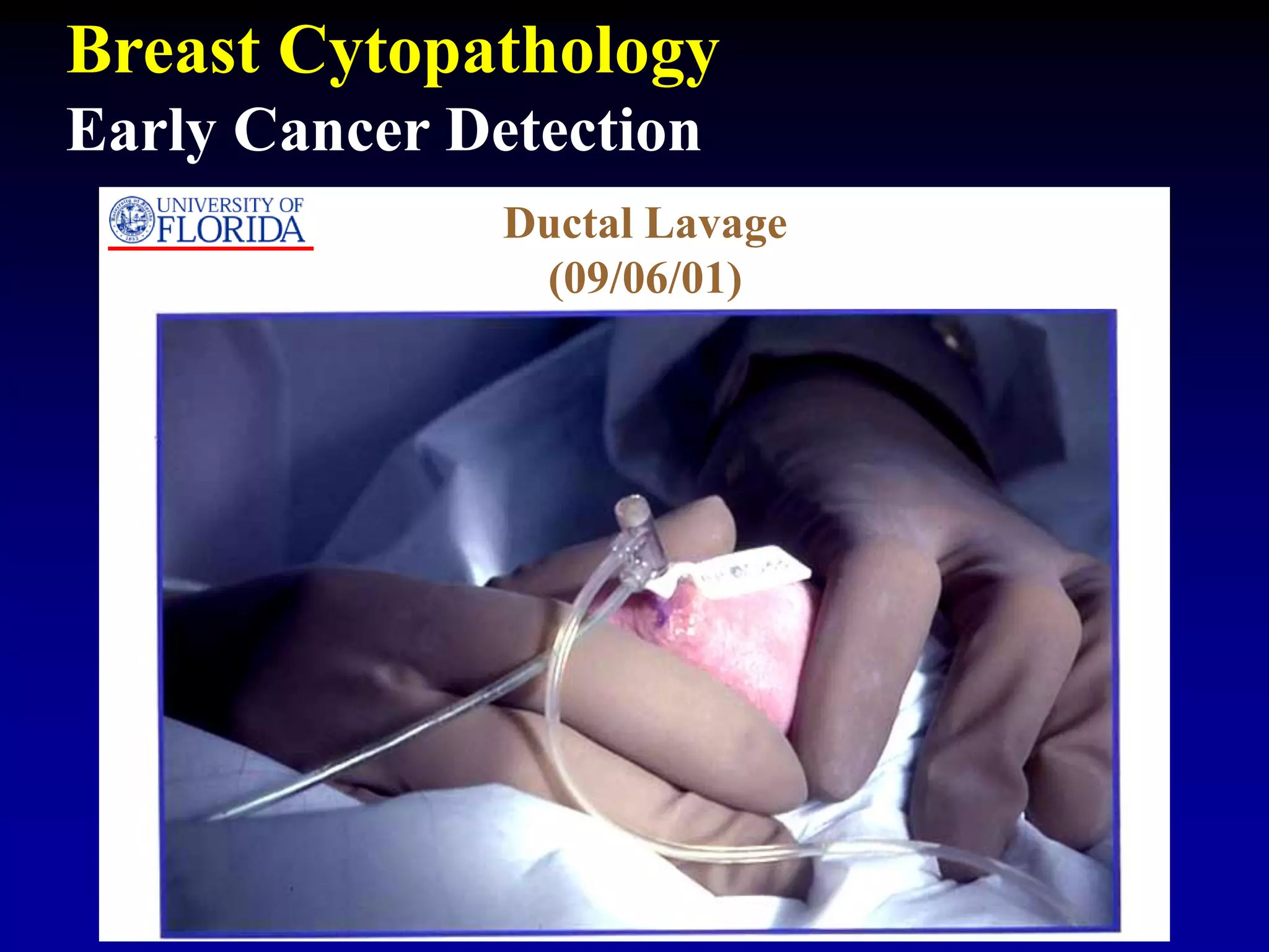 Ductal Lavage
(09/06/01)
Breast Cytopathology
Early Cancer Detection
 