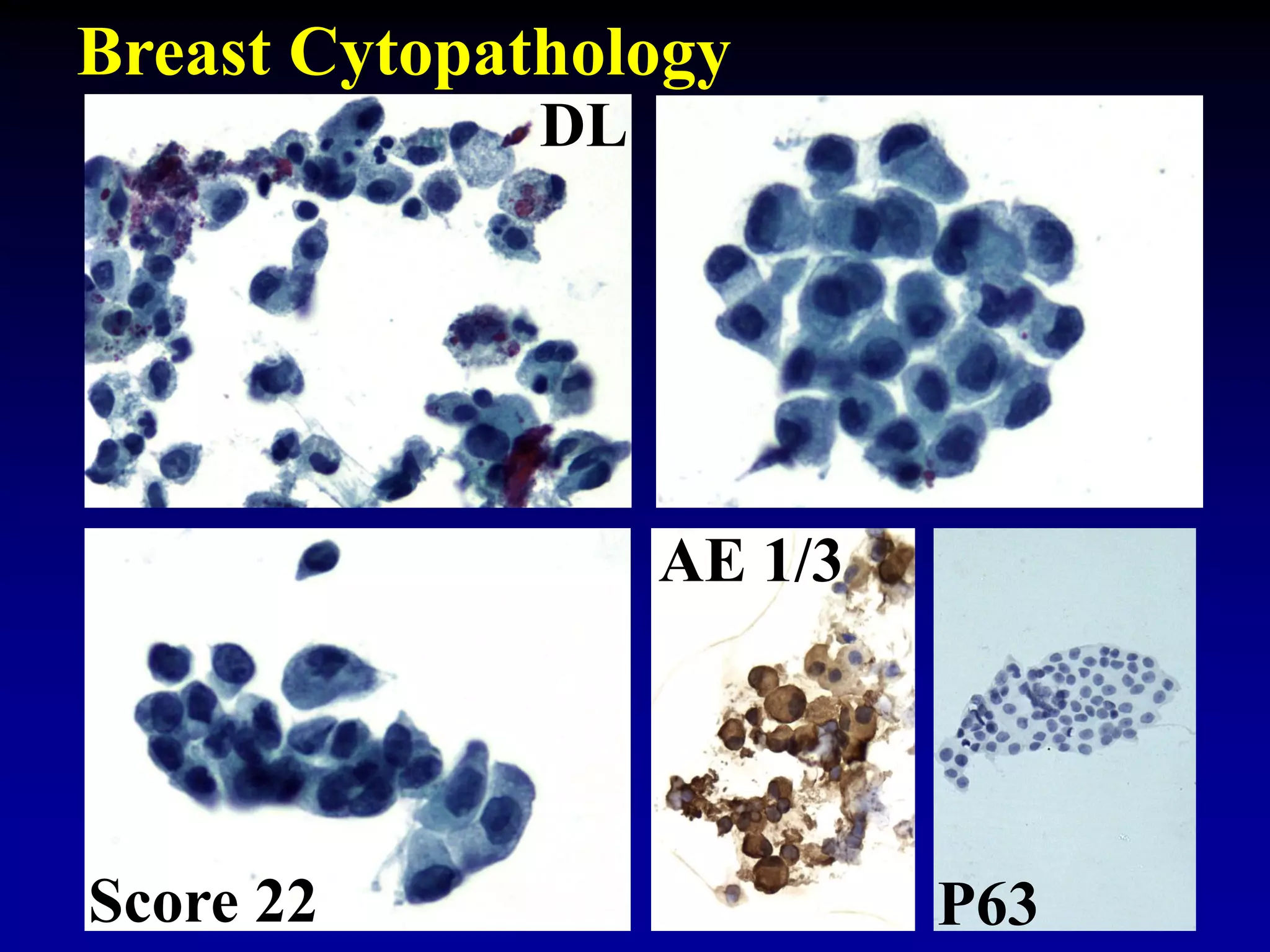 Score 22
DL
AE 1/3
P63
Breast Cytopathology
 
